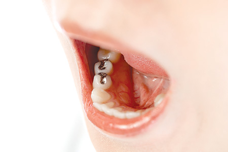 ベルビュー・プレミア・デンタル 歯の詰め物、銀歯の替え時