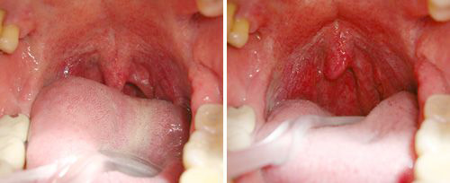 ベルビュー・プレミア・デンタル 緩んだ喉の奥の粘膜組織